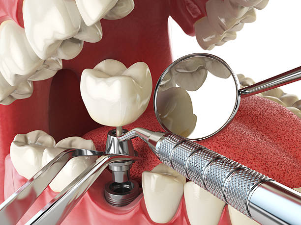 Best Dentist for Tooth Abscess  in Mohave Valley, AZ